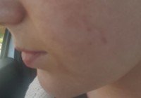 After Microneedling